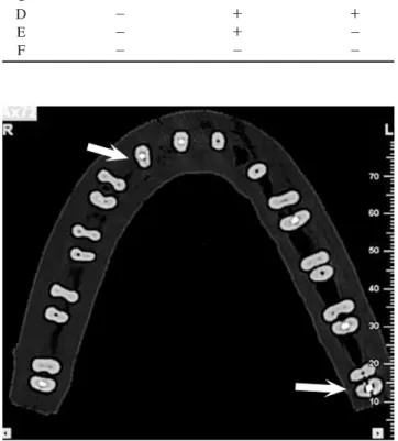 Fig. 1. An axial CBCT image shows the molar and premolar teeth with vertical root fracture.