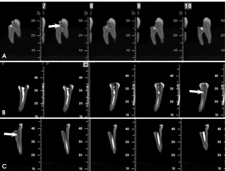 Fig. 2. Cross sectional images of molar and premolar teeth with vertical root fracture