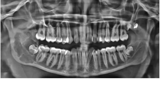 Fig. 1. A panoramic radiograph shows a well-defined  multiloculat-ed radiolucent lesion extending from the distal border and apex of lower right second molar into the ramus till approximately 3 mm away from the sigmoid notch enclosing the developing tooth 