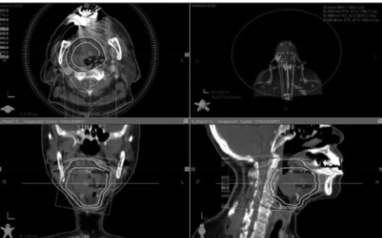 Fig. 1. Pathologic images of patients. A : Pathology of the patient A-Cribriform growth pattern of ACC, H&amp;E staining ×200