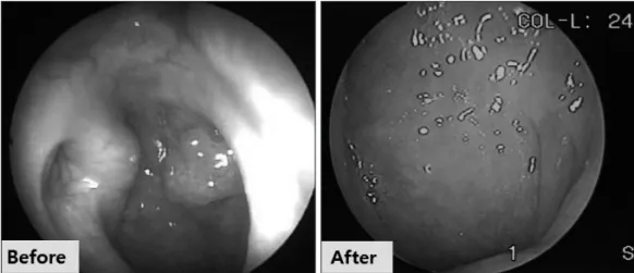 Fig. 3. Laryngoscopic image before and after CCRT.