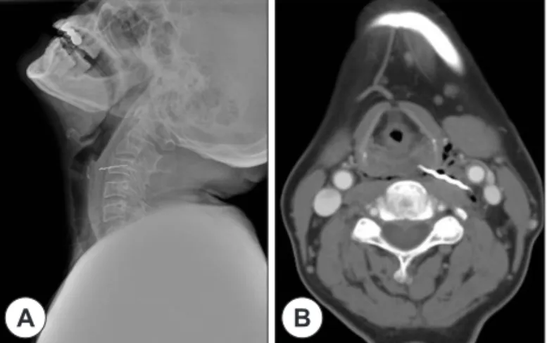 Fig. 1. Neck lateral view(A) and Neck CT(B) show about 4 cm sized  metallic wire in retropharynx.