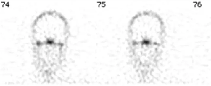 Fig. 2. SPECT study shows very mild uptake in the right mandibu- mandibu-lar condyle.