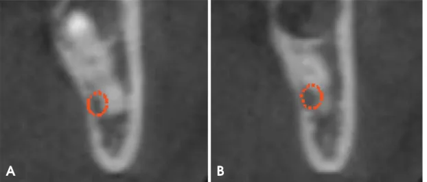 Fig. 1. Initial cross-sectional cone-beam computed tomographic (CBCT) images of the site show the contact between the mandibular canal and the curvatures of the mesial (A) and distal (B) roots, depicted in different CBCT cuts