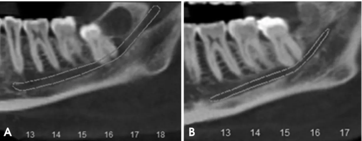 Fig. 3. Initial (A) and final (B) coronal panoramic CBCT reconstruction images of the site show the relationship between the lower third molar roots and the mandibular inferior alveolar canal.