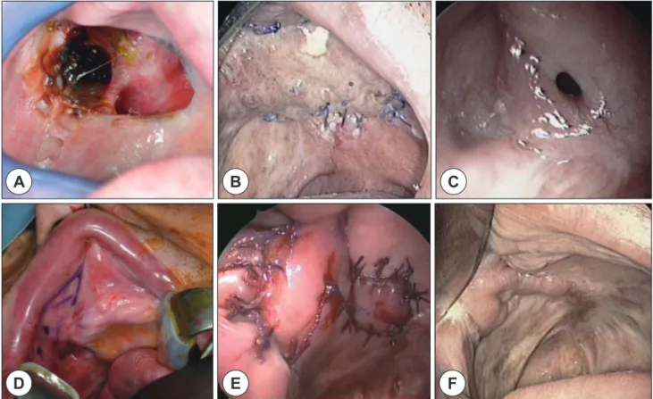 Fig. 1. Preoperative(A, B and C), intraoperative(D) and postoerative(E and F) findings in case 1 patient