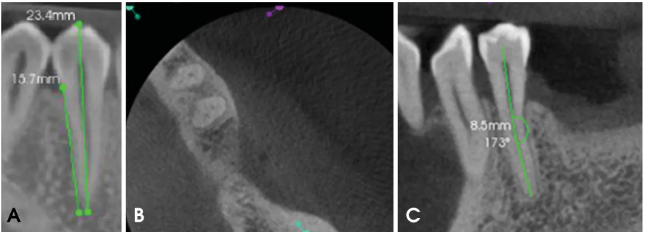 Fig. 1. A. Total tooth length from the cuspid to the apex and root length from the cemento-enamel junction to the apex are measured using a mesiodistal cone-beam computed tomography (CBCT) image