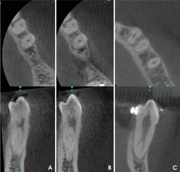 Fig. 2. A. Axial (up) and buccolingual (down) CBCT images show the Vertucci type II configuration