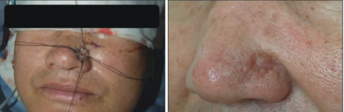 Fig. 2. Postoperative features. Left : Immediate postoperative feature, Right : 6 months after the operation.