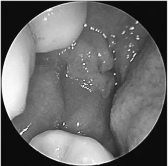 Fig. 1. The endoscopic exam shows a ulcerofungating mass on  retromolar trigone on right side.