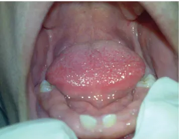 Fig. 1. Intra-oral photograph shows absence of multiple teeth in the mandible.