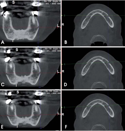 Fig. 1. The angulation adjustment procedure of the CBCT images is seen. Coronal (A) and axial (B) slices before angulation adjustment