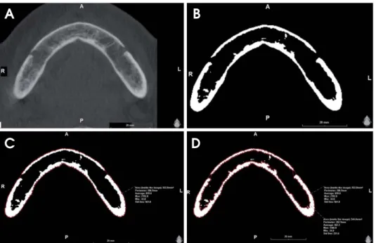 Fig. 2. Measurement procedure for the radiographic density (gray  val-ues) and the area (mm 2 ) of the whole bony region and for the trabecular bone alone the mandibular body slice