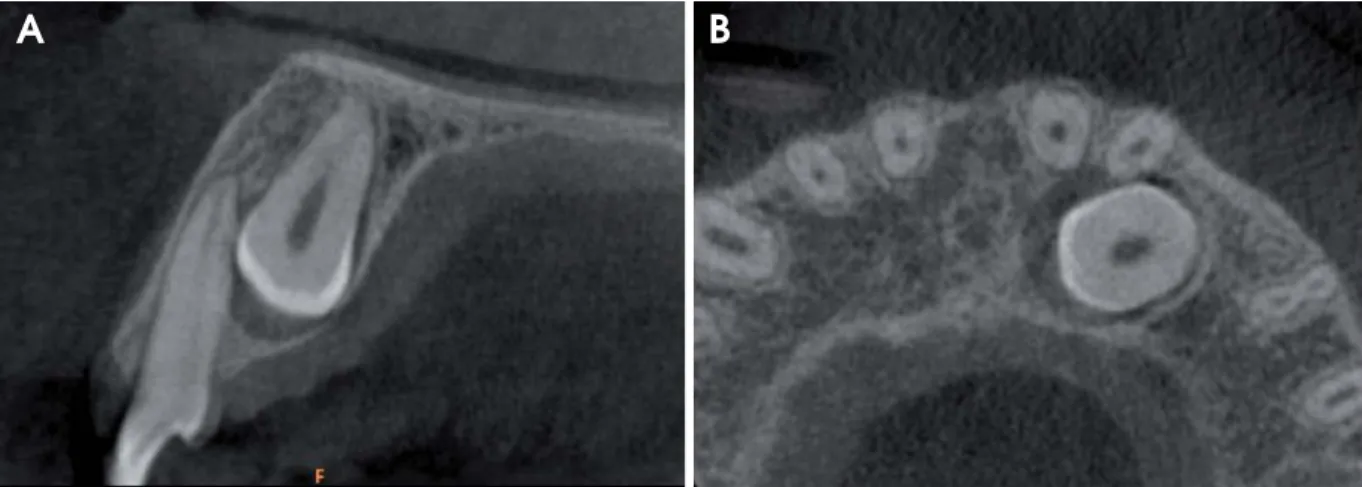 Fig. 1. Sagittal (A) and axial (B) slices of cone-beam computed tomography (CBCT) show an impacted canine causing mild root resorption of the lateral incisor.