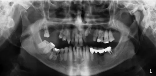 Fig. 1. Panoramic image shows multiple instances of idiopathic  in-ternal and exin-ternal root resorption.