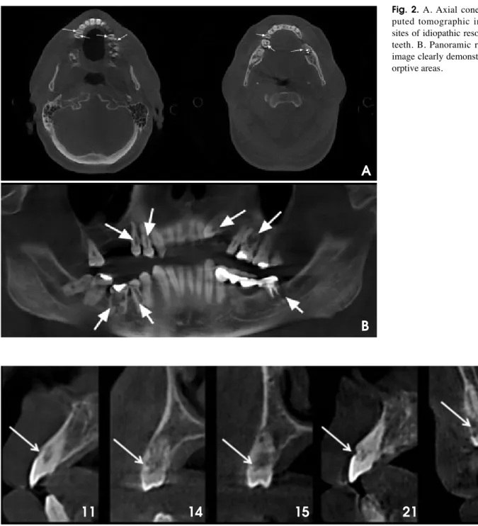 Fig. 2. A. Axial cone-beam com- com-puted tomographic images show sites of idiopathic resorption of the teeth