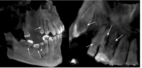 Fig. 5. Three-dimensional cone- cone-beam computed tomographic  vol-ume rendering images clearly show external and internal resorption (arrows).
