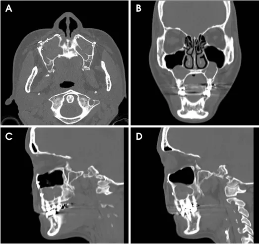 Fig. 2. Computed tomography images show low-attenuation lesions in both maxillary sinuses