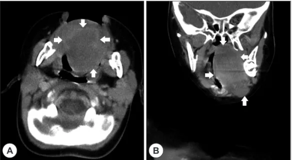Fig. 1. Enhanced CT images of the mass in axial(A) and coronal(B) cuts. A maximum 4.5 cm irregular heterogenous enhancing solid  and cystic mass at tongue base with extension to Lt