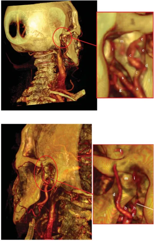 Fig. 1. Posterior view of computerized tomography rendering of the  temporo-mandibular joint of a 30-year-old  heal-thy female