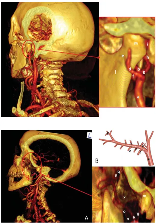Fig. 3. Posterior view of computerized tomography rendering of the  temporo-mandibular joint of a 30-year-old  heal-thy female