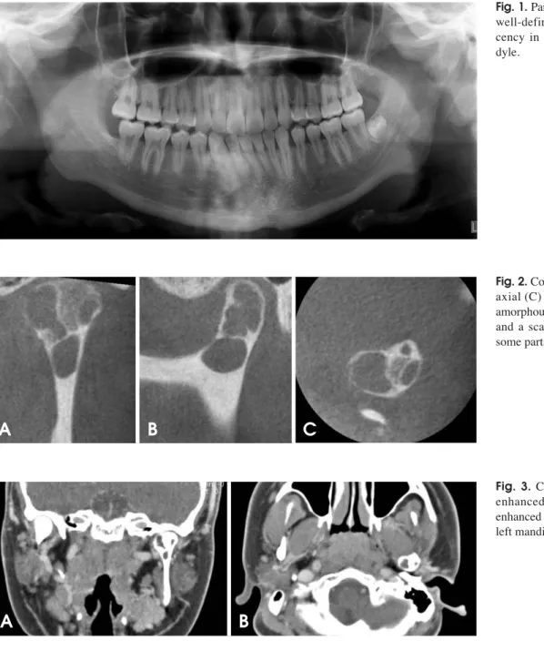 Fig. 1. Panoramic radiograph shows well-defined multilocular  radiolu-cency in the left mandibular  con-dyle.