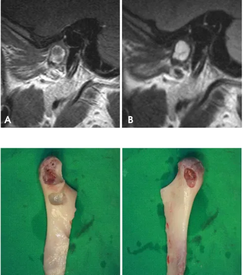 Fig. 4. MRI shows homogeneous interme- interme-diate SI on the T1-weighted image (A) and homogeneous high SI on the T2-weighted image (B).