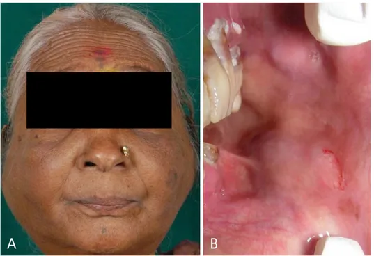 Fig. 1. A. Bilateral enlargements of parotid and submandibular glands are seen. B. Two swellings  measur-ing 2 cm×3 cm are seen in the  buc-cal vestibule in the region of the upper and lower second molar.