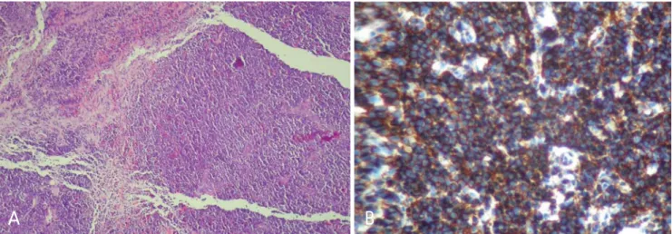 Fig. 4. A. Histopathological examination shows diffuse large B-cells with moderate cytoplasm and large round vesicular nuclei having prominent nucleoli (H&amp;E stain, ×20)