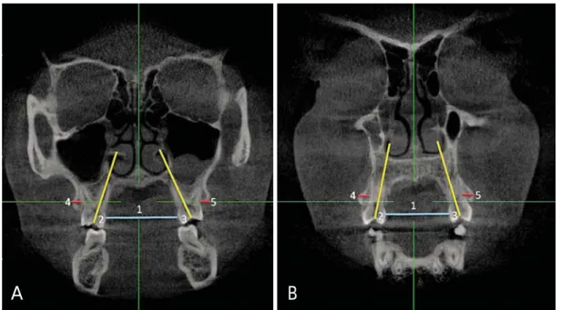 Fig. 1. Two-dimensional coronal slices perpendicular to the midsaggital plane to carry out the linear and angular measurements for this study