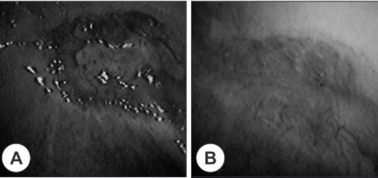 Fig. 5. Postoperatvie oral cavity finding. A : 1 month later, post- post-operatively. B : 2 months later, postpost-operatively.