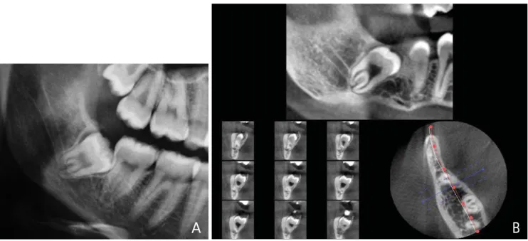 Fig. 2. A. Cropped panoramic radiograph shows the darkening of both roots of the right impacted mandibular third molar