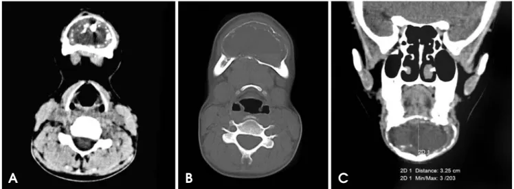 Fig. 1. A. An extraoral photograph shows swelling of the mandible. B.