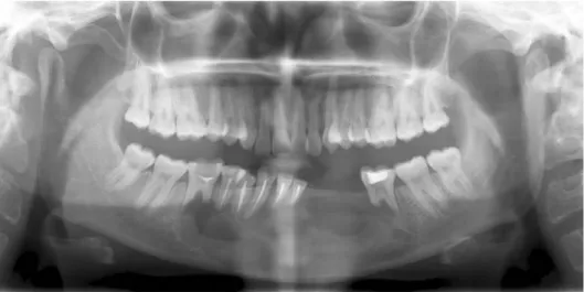 Fig. 6.  A six month postoperative panoramic radiograph shows  nor-mal healing and no signs of  recur-rence
