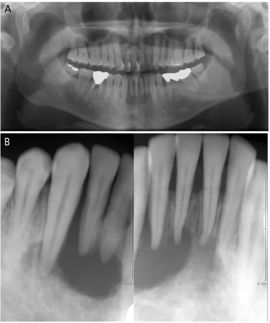 Fig. 1. A. A panoramic radiograph shows a radiolucent lesion with a well-defined margin from the left lower lateral incisor to the right lower canine