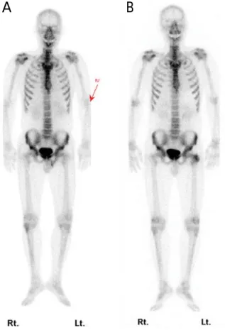 Fig. 5. Bone scintigraphy. A. The initial study shows normal up- up-take of the radiotracer in the trochanteric portion of the left femur.