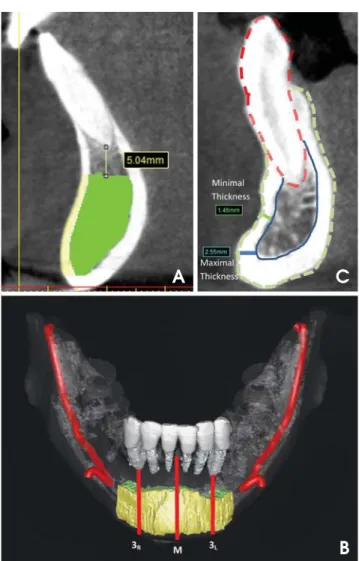 Fig. 3. A. Cortical bone (yellow) and cancellous bone (green) are defined on the cross-sectional image
