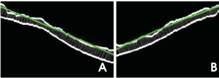 Fig. 2.  A second-order polynomial function used to carry out the distance measurements between the boundaries of the cortical bone on the right (A) and the left (B) sides.