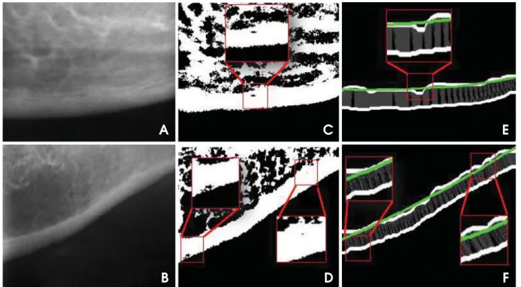 Fig. 3.  Mandibular cortical bone images show the left cortex affected by noise (boxes in red), also shown in enlarged view