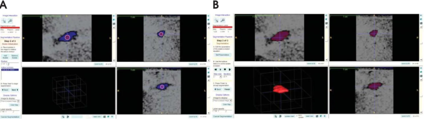 Fig. 1. A. Selection of reference points in the area of interest is performed. B. ITK-SNAP software allows semiautomatic segmentation of calcifications.