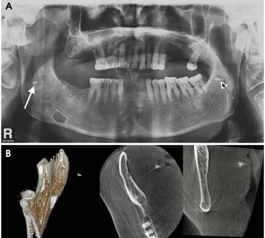 Table 1. Calcification characteristics of cases