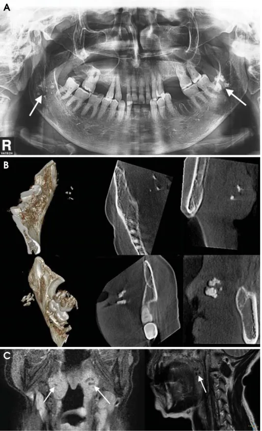 Fig. 4. Case 1. Panoramic, CBCT, and MR images. A. The panoramic radiograph show bilateral  calcifica-tions overlapping the middle  port-ion of the ascending ramus, which suggest benign, intra-osseous lesions (white arrows)