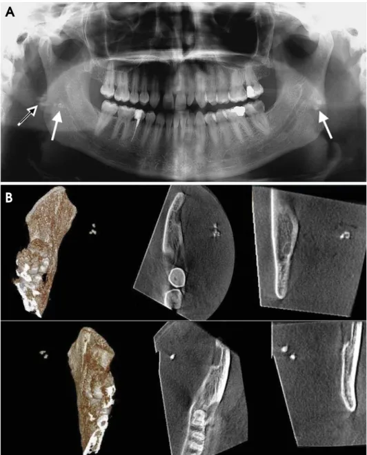 Fig. 5. A. The panoramic radiograph of a patient shows bilateral  tonsil-loliths. The white and black arrow indicates that some of the radiopaque images on the right side, which do not overlap the ramus, led to a  pro-bable diagnosis of soft-tissue  calci-