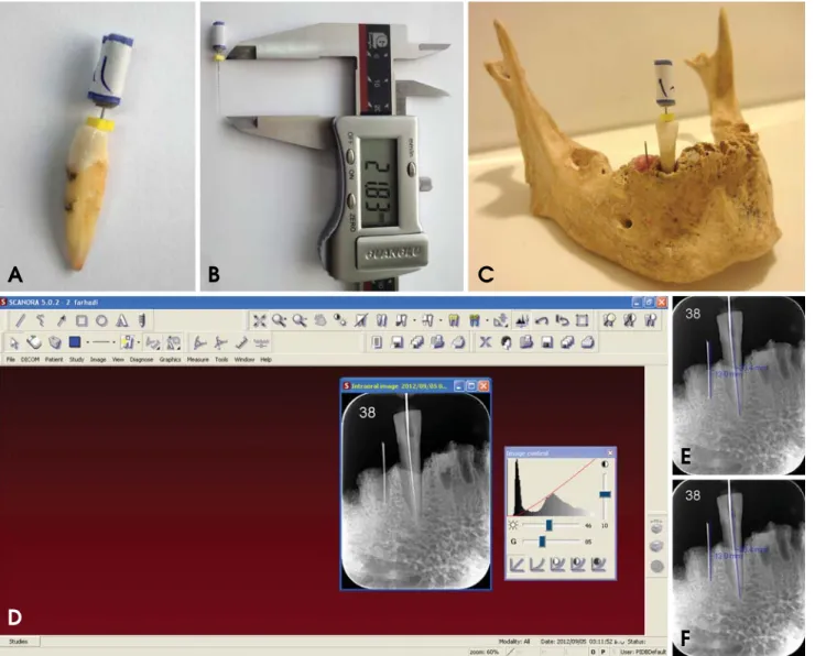 Fig. 1. A. Insertion of an endodontic file into the canal. B. File length measurement (standard value)