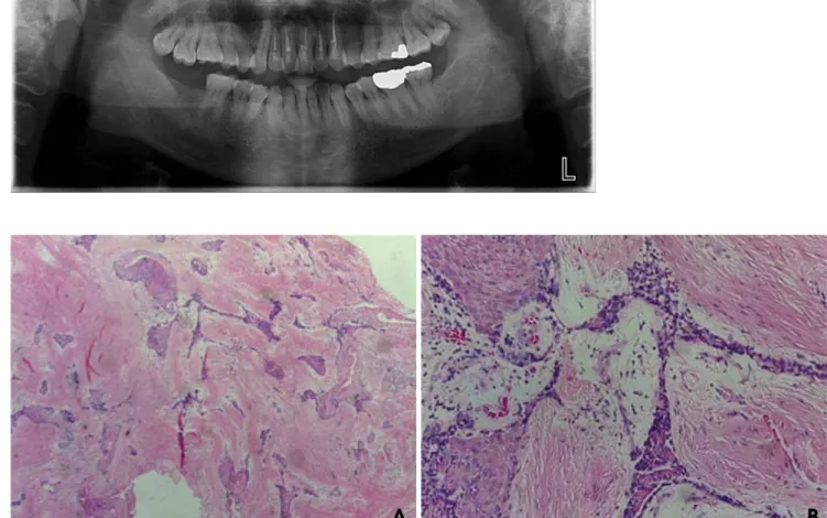 Fig. 4.  A. Histopathologic examination 4 years after the first surgery shows the desmoplastic type of ameloblastoma (H&amp;E stain, 40×)
