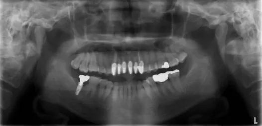 Fig. 5. Five years after the second surgery. The panoramic radiograph reveals a soap bubble appearance in the periapical area of the right first and second molars of the maxilla.