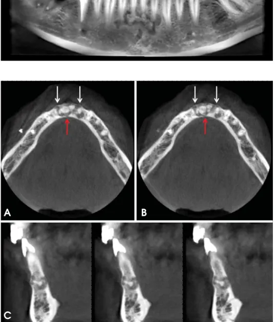 Fig. 2. A. An axial CBCT image shows the expansion of the buccal cortex (white arrows) and  discon-tinuity of the lingual cortex (red arrow)