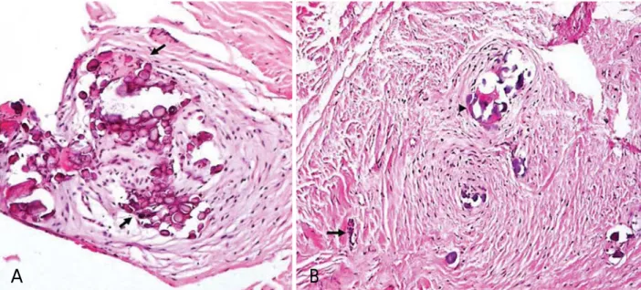 Fig. 4. A. Microscopic examination shows type 1 calcifications arranged in whorled structures