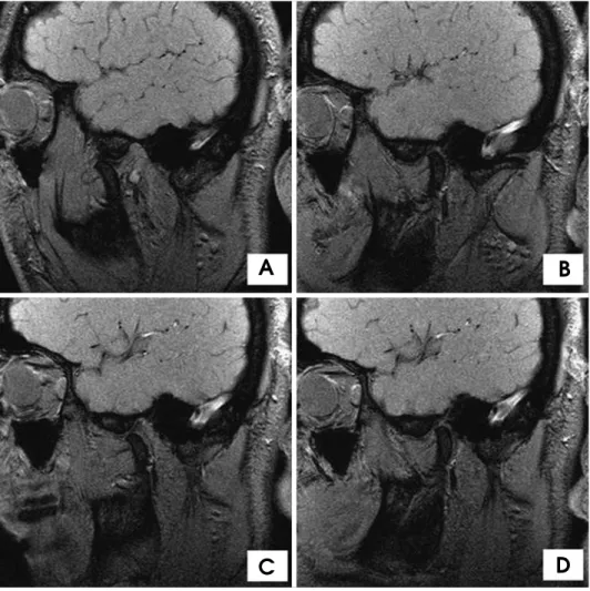 Fig. 2. Case 1: MRI images of the left TMJ. A. Open-mouth position before injection. B