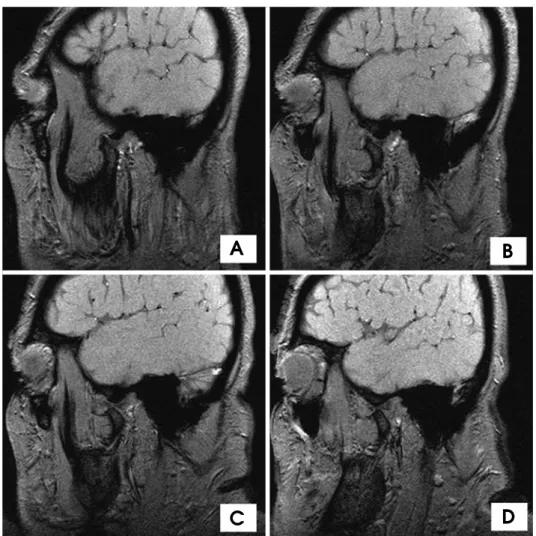 Fig. 3. Case 2: MRI images of the open-mouth position. A. The left TMJ before injection